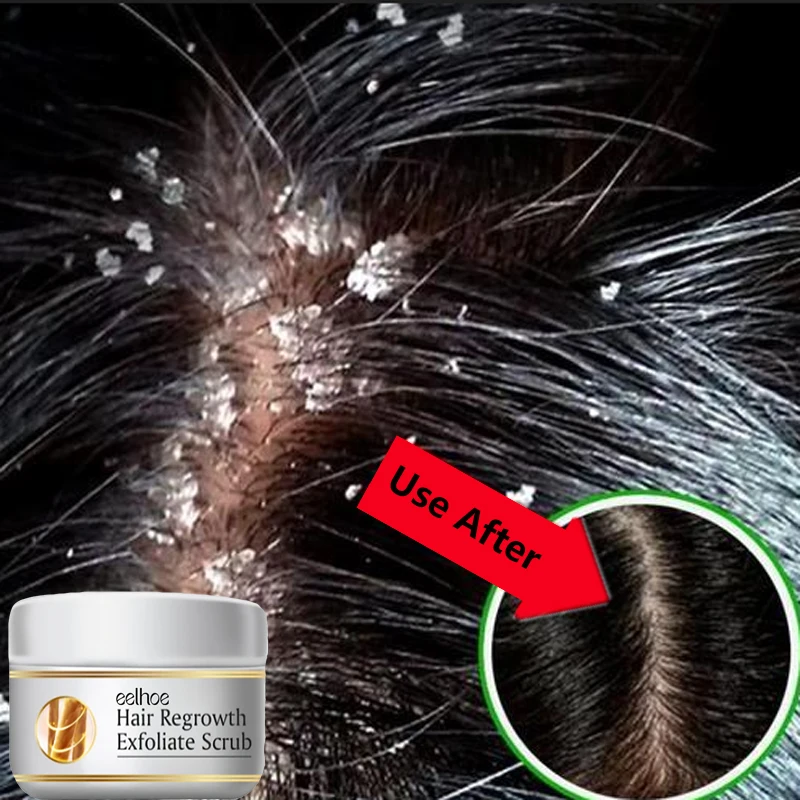 Hair Care Dandruff - Snelle Anti-roos Haarbehandeling Scrub Jeukherstel Hoofdhuidreiniging