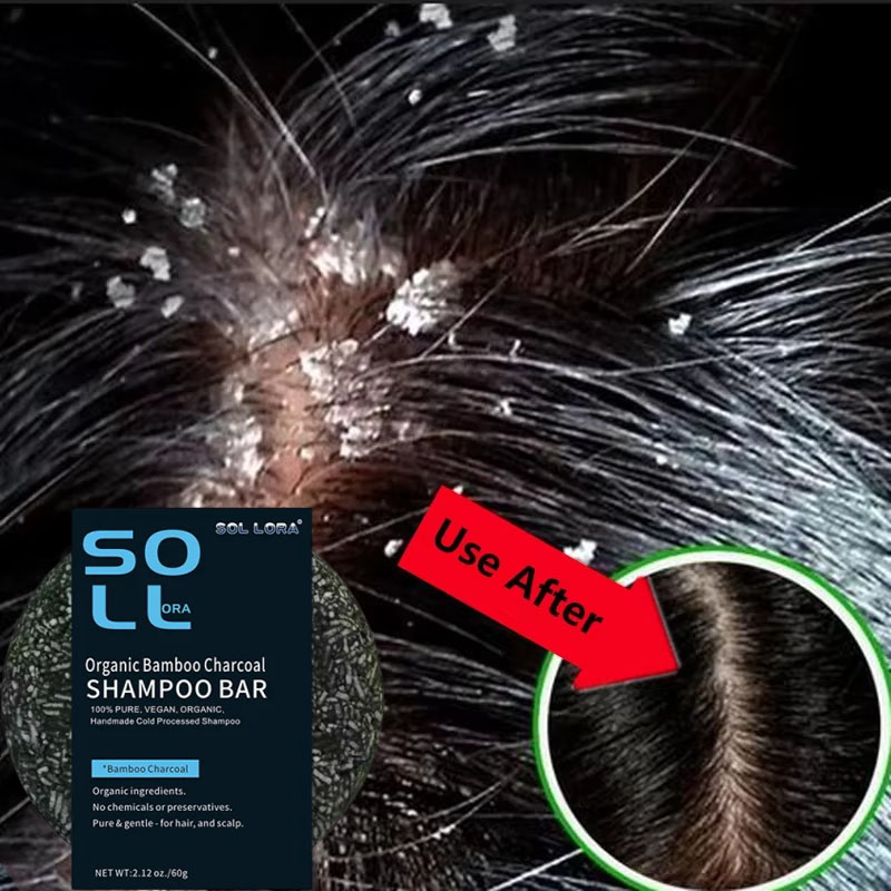 Hair Care Dandruff - Snelle Anti Roos Haarbehandeling Zeep Jeuk