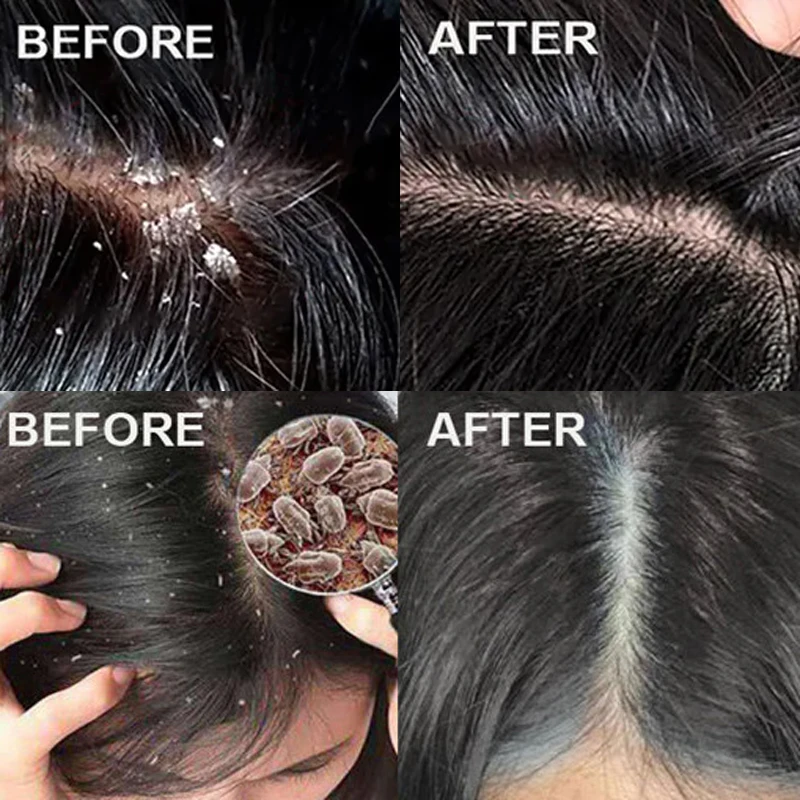 Snelle Anti-roos Haarbehandeli - Hair Care Dandruff recensie en prijs