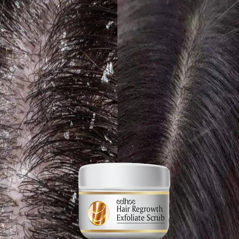 Snelle Anti-roos Haarbehandeli - Hair Care Dandruff recensie en prijs