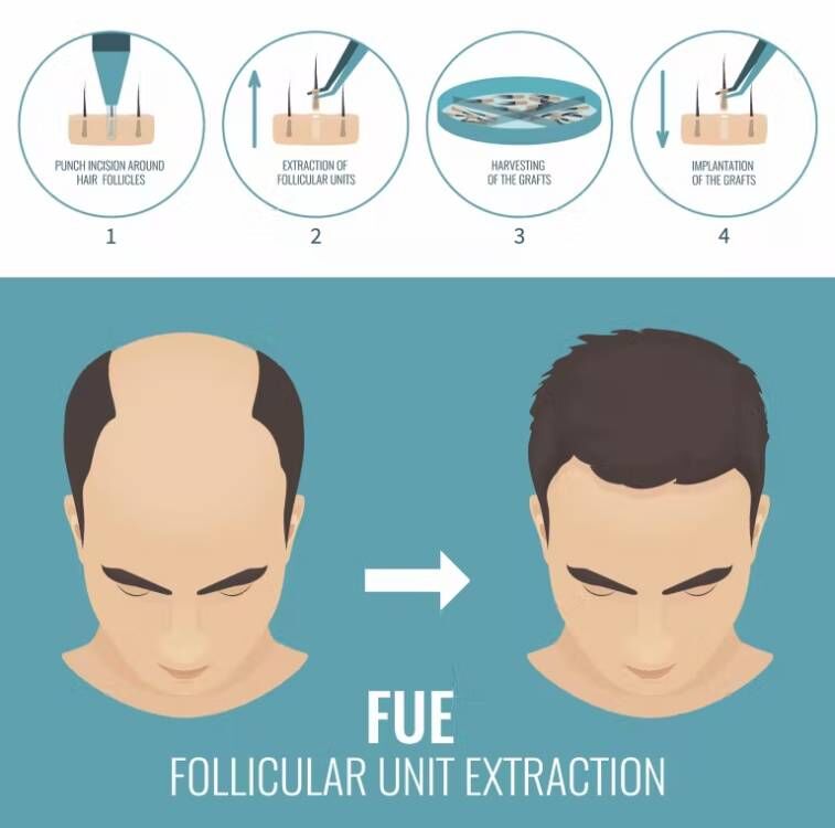 Fue Hair Implantaat Micro Moto - Hair Care Vegan recensie en prijs