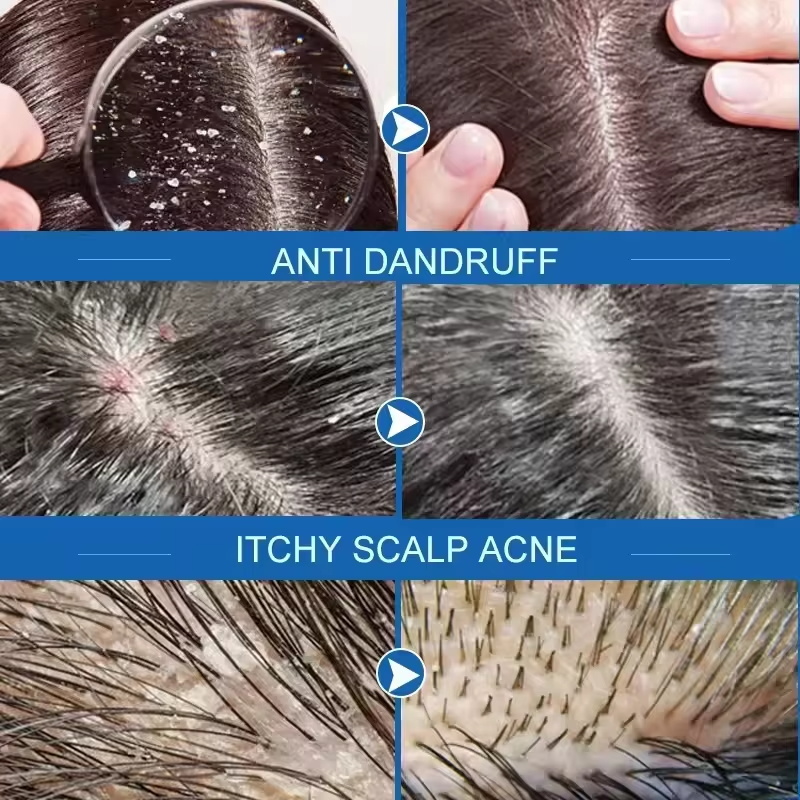 Snelle Anti Roos Haarbehandeli - Hair Care Dandruff recensie en prijs
