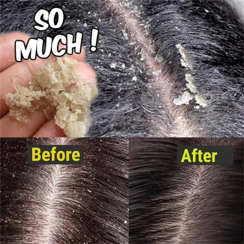 Snelle Anti Roos Haarbehandeli - Hair Care Dandruff recensie en prijs